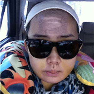 上海華美李志海做的v－line瓜子臉手術(shù)，果太好了~哈哈哈~