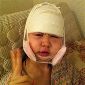 做了v－line瓜子臉手術(shù)八個月了，果很好，看看前后對比照片吧~