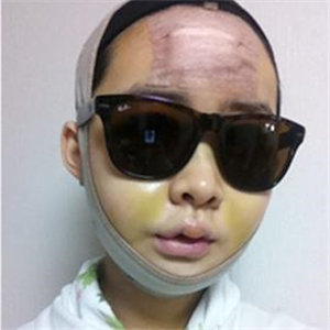 做了v－line瓜子臉手術(shù)八個月了，果很好，看看前后對比照片吧~