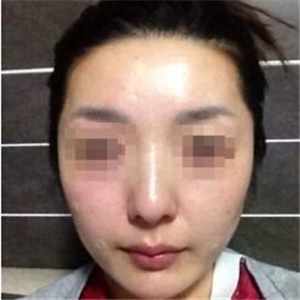 打B****告別大餅?zāi)?，恢?fù)前后的對(duì)比果照片給你們看看哦
