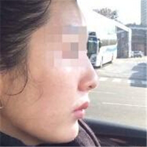 打B****告別大餅?zāi)?，恢?fù)前后的對(duì)比果照片給你們看看哦