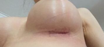 假體隆胸胸下切口還有痕跡圖,不過已經(jīng)比開始淡化了很多