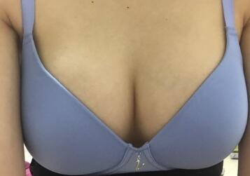 點擊圖片查看胸下切口假體隆胸恢復(fù)分享