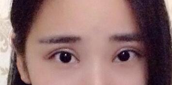 切開雙眼皮價格2680元,割雙眼皮拆線后圖片