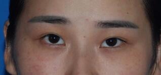 切開雙眼皮整形前圖片,價格2680元