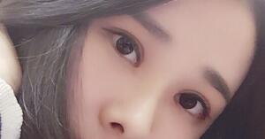 切開雙眼皮兩個辦月了