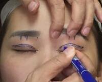 切開雙眼皮價格2680元，費用不貴果卻很好