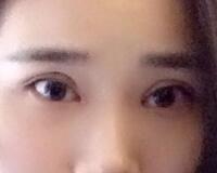 切開雙眼皮價格2680元，費用不貴果卻很好