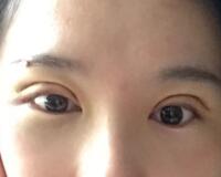 割雙眼皮過程恢復(fù)圖分享給大家，單眼皮變雙眼皮