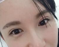 割雙眼皮過程恢復(fù)圖分享給大家，單眼皮變雙眼皮