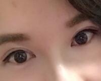 割雙眼皮過程恢復(fù)圖分享給大家，單眼皮變雙眼皮