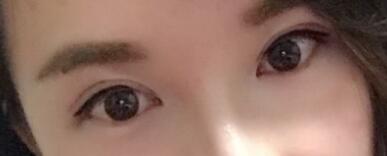 割雙眼皮過(guò)程恢復(fù)圖分享給大家,單眼皮變雙眼皮