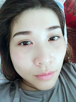 大家來(lái)評(píng)一下葛紅做的內(nèi)切去眼袋怎么樣