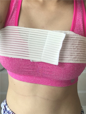 邱凌燕給我做了假體隆胸后 就挺了起來(lái)