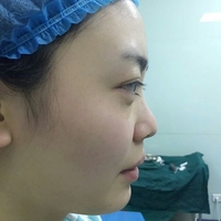 硅膠假體隆鼻后恢復得很漂亮下一步的目標是自體脂肪全臉填充