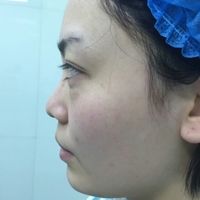 硅膠假體隆鼻后恢復得很漂亮下一步的目標是自體脂肪全臉填充