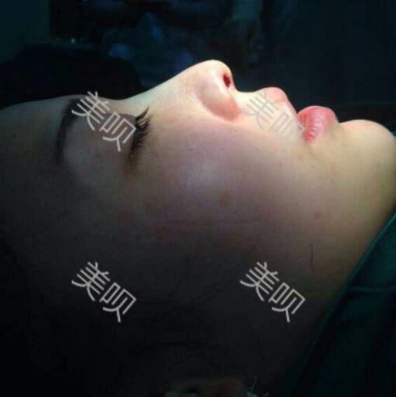 硅膠假體隆鼻后恢復得很漂亮下一步的目標是自體脂肪全臉填充