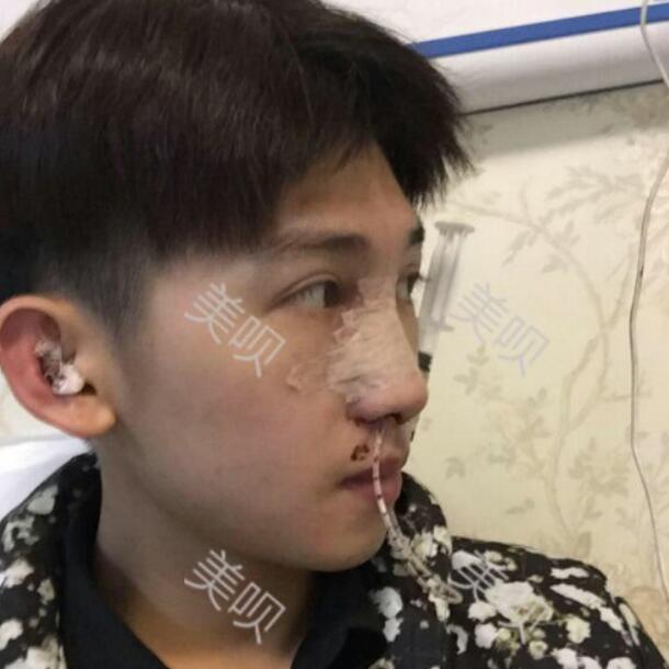 給大家分享一下我的膨體隆鼻恢復(fù)過程我要變得更帥哦