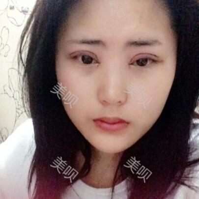 給大家看看我做的切開雙眼皮+開眼角恢復(fù)全過程很漂亮哦