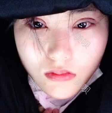 給大家看看我做的切開雙眼皮+開眼角恢復(fù)全過程很漂亮哦