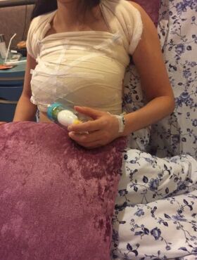 假體隆胸終于讓我擺脫了平胸妹的稱號(hào)，天津伊美爾熊斌做的