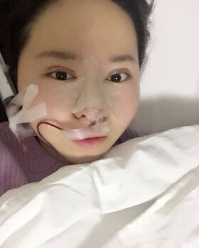 路衛(wèi)國(guó)給我做隆鼻整形后鼻子變得特別秀麗