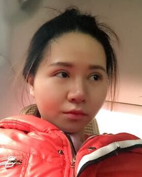 路衛(wèi)國(guó)給我做隆鼻整形后鼻子變得特別秀麗