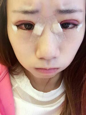 做了全切雙眼皮和開內(nèi)眼角，術(shù)后果較為滿意