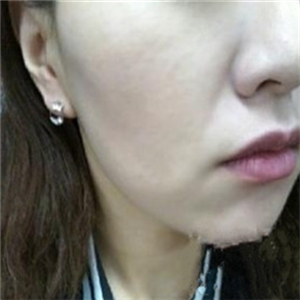 自體脂肪填充去法令紋一個星期了，分享我的恢復(fù)對比照片哦~~