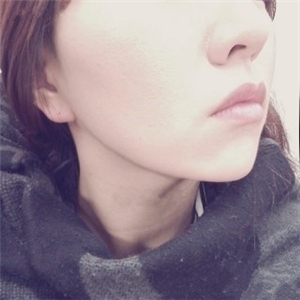 自體脂肪填充去法令紋一個星期了，分享我的恢復(fù)對比照片哦~~