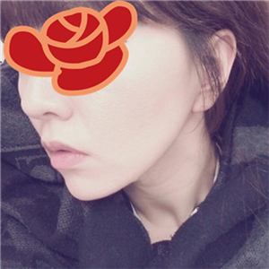 自體脂肪填充去法令紋一個星期了，分享我的恢復(fù)對比照片哦~~