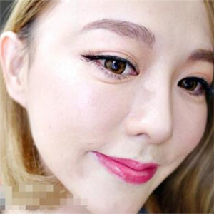 韓式埋線面b提拉一個月的果照片，前后對比差別有點大哦~