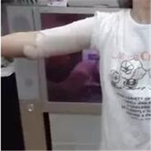 手臂吸脂手術(shù)八個(gè)月了，看看我的前后對(duì)比果圖片吧~~