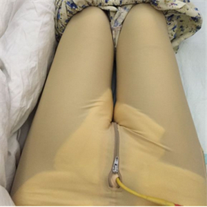 大腿部吸脂減肥一個月了，曬一下恢復過程和對比照片哇~~