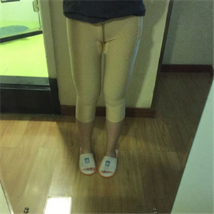 大腿部吸脂減肥一個月了，曬一下恢復過程和對比照片哇~~
