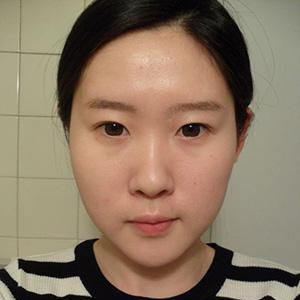 看我自體軟骨墊鼻尖恢復(fù)過(guò)程的照片，前后對(duì)比差別有點(diǎn)大呢~