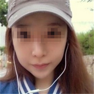 伊萊美做磨骨整形手術半年多了，分享下恢復過程照片哦~~~