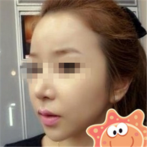 伊萊美做磨骨整形手術半年多了，分享下恢復過程照片哦~~~