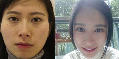 大腿吸脂做自體脂肪面部填充三個(gè)月的前后對(duì)比照片