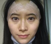 大腿吸脂做自體脂肪面部填充三個(gè)月了，分享給大家