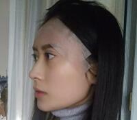 大腿吸脂做自體脂肪面部填充三個(gè)月了，分享給大家