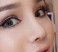 隆鼻整形真實案例恢復(fù)過程分享