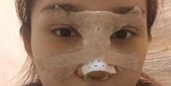 隆鼻整形手術(shù)