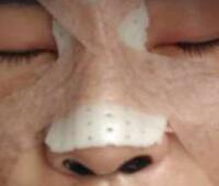 自體軟骨隆鼻手術(shù)果和恢復(fù)過程圖分享