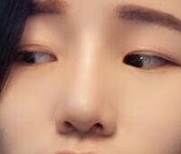 自體軟骨隆鼻手術(shù)果和恢復(fù)過程圖分享