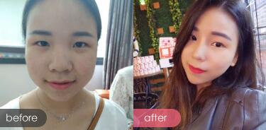 隆鼻整形——自體耳軟骨隆鼻,隆鼻前后對(duì)比圖