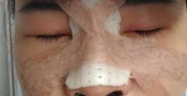 自體耳軟骨隆鼻整形后的圖片