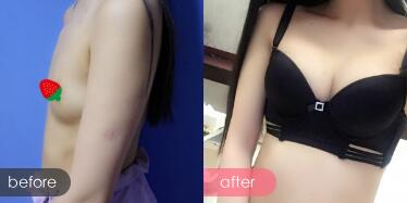 假體隆胸,假體隆胸價格為28000元