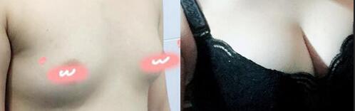 自體脂肪隆胸前后對(duì)比圖
