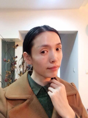 玻尿酸面部填充前后過程及對比圖片，來看看果如何